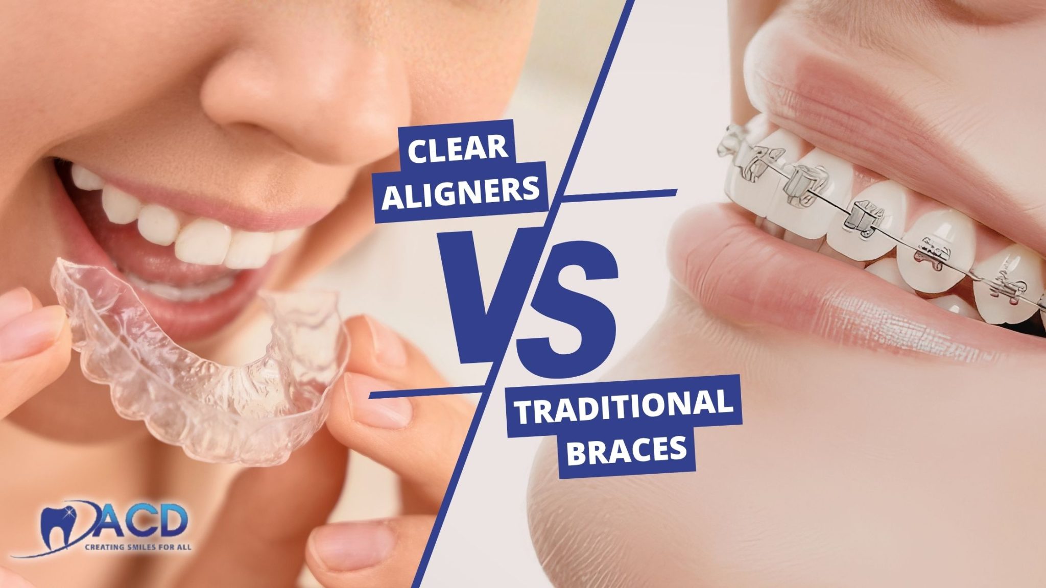 Clear Aligners vs. Braces for Adults