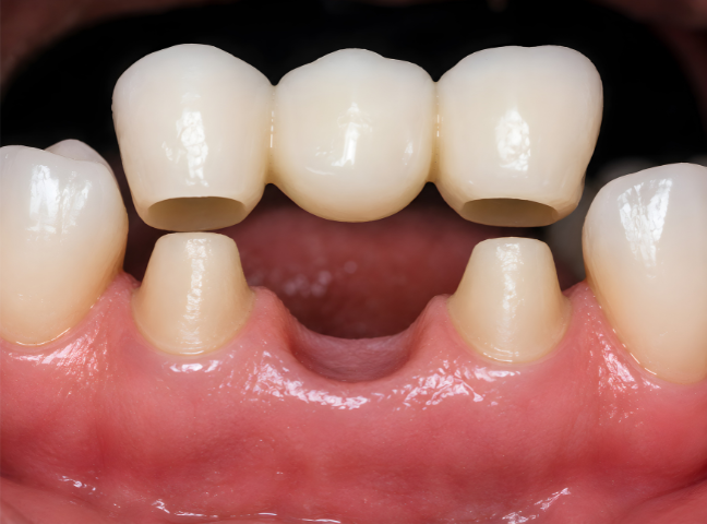 Dental Crowns & Bridges