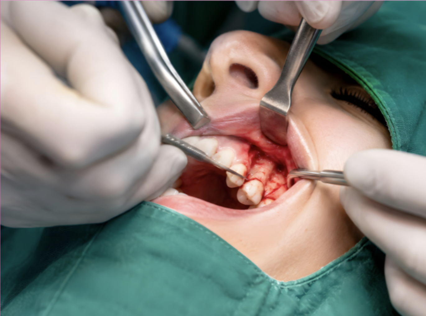 Oral Surgery