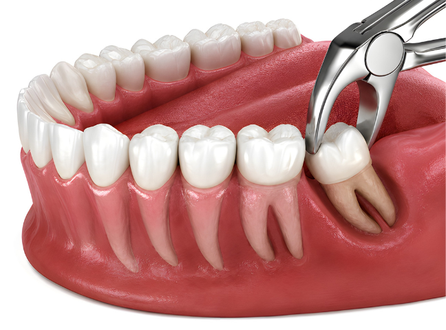 Wisdom Teeth Removal